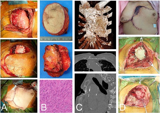 The same case as in Figure 1 with a malignant spindle cell sarcoma in the superficial chest wall. The tumor and partial sternum resection was performed with the second-to-fourth ribs, leaving the posterior cortex of the sternum (A-top). Gore-Tex® covers the chest wall defect and the local transposition flap was elevated (A-middle and -bottom). The resected material shows the chest wall and the bisected sternum (B-top and -middle). The histologic evaluation shows spindle cell proliferation arranged in fascicles with a storiform pattern and atypia (B-bottom). CT depicted the remaining anterior bones and Gore-Tex® sheet (C-top). The posterior cortex was preserved (C-middle). A fracture, possibly due to spinal kyphosis, occurred 3 months after the operation (C-bottom). The edge of the flap was necrotic (D-top). The wound was opened (D-middle) and the Gore-Tex® sheet was removed. Fibrous reactive tissue was confirmed on the surface of the lung (D-bottom).