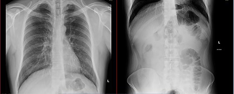 Chest and plain abdominal X-ray at the presentation.