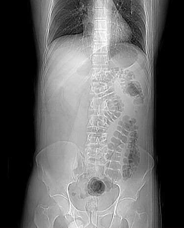 CT scout showing the position of the colon.