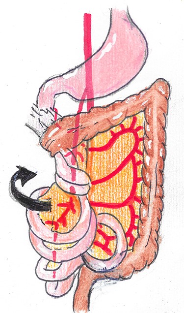 First step of Ladd’s operation.