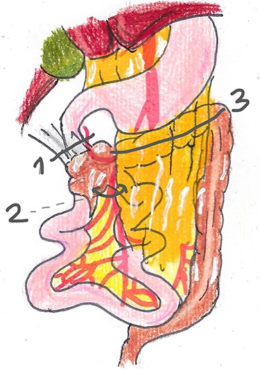 Second step of Ladd’s operation.