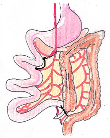 Last step of Ladd’s operation.