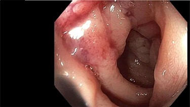 Colonoscopic finding of sigmoid stricture.
