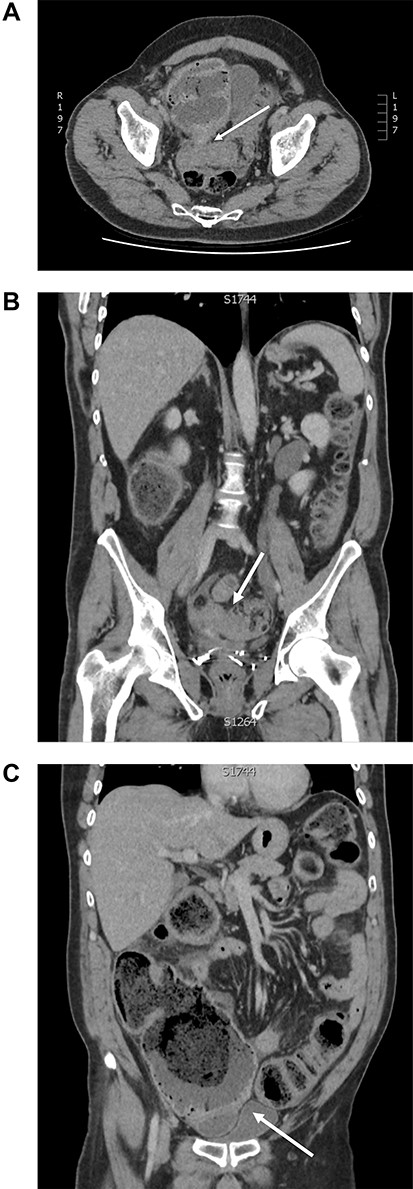 Computed tomography of large bowel obstruction and pneumoperitoneum: (A) axial view depicting dilated caecum with pneumatosis and adherence to the sigmoid stricture (white arrow); (B) coronal view depicting sigmoid stricture (white arrow); (C) coronal view depicting pneumoperitoneum, dilated caecum with adhesion to sigmoid colon stricture (white arrow).