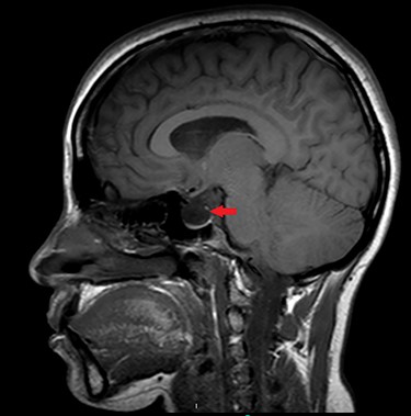 Sagittal MRI of brain, T1 weighted image, showing evidence of empty Sella Turcica (arrow).