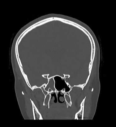 CT of paranasal sinuses, showing opacification of right sphenoid sinus.