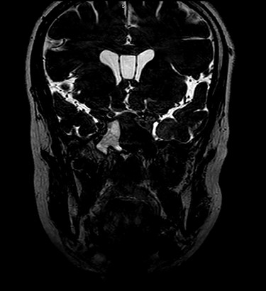 Coronal MRI of brain, T2 weighted image, showing opacification of right sphenoid sinus.
