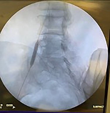 Angioplasty of right iliac artery being performed.