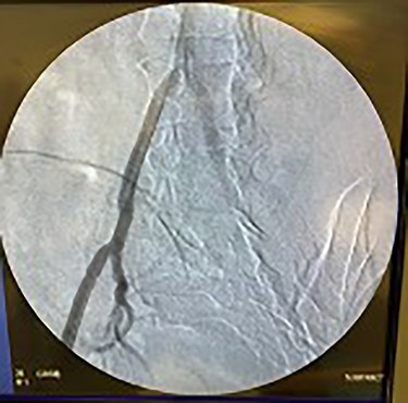 Fluoroscopy showing dilation of the right iliac vessel post-angioplasty.