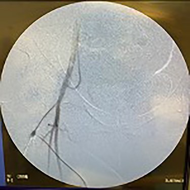 Fluoroscopy of right iliac artery showing improved perfusion.