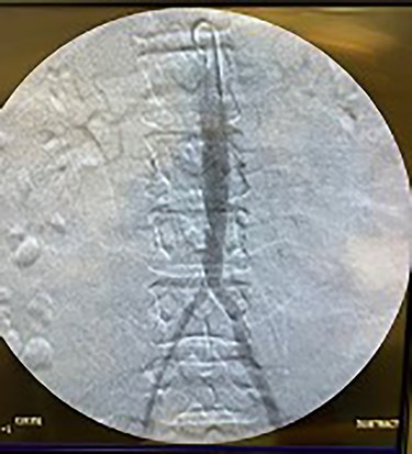 Fluoroscopy of distal aorta showing narrowing.