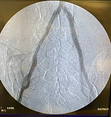 Fluoroscopy of bilateral iliac arteries showing significant arterial disease.