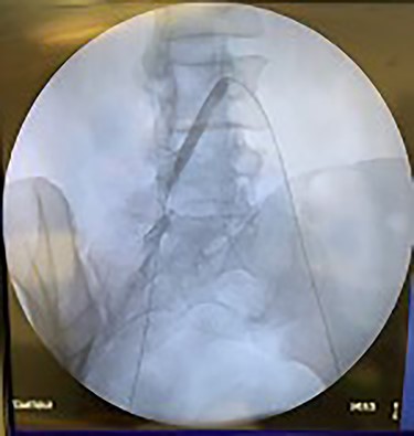 Angioplasty of right iliac artery being performed.