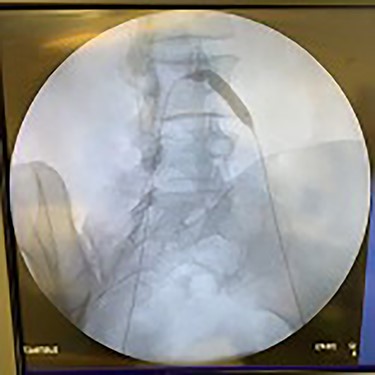 Angioplasty of left iliac artery being performed.