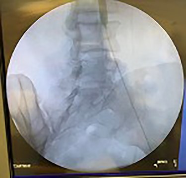 Angioplasty of distal aorta being performed.
