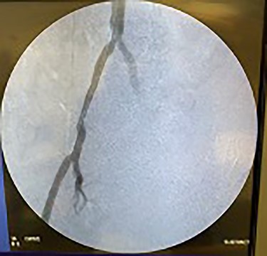 Fluoroscopy showing dilation of the distal aorta post-angioplasty.