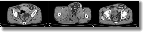 Axial postcontrast CT of the abdomen at the level of pelvis showing a defect in the peritoneal lining in the left inguinal region with protrusion of bowel loops, accompanying mesentery and vessels into the left scrotal sac via inguinal canal suggestive of left inguinoscrotal hernia.