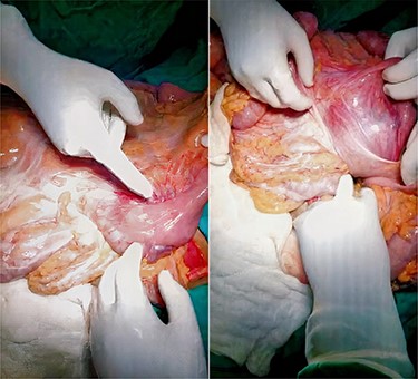 Intraoperative picture showing hernia contents.