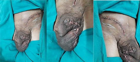 Picture showing incision wound on fourth postoperative day.