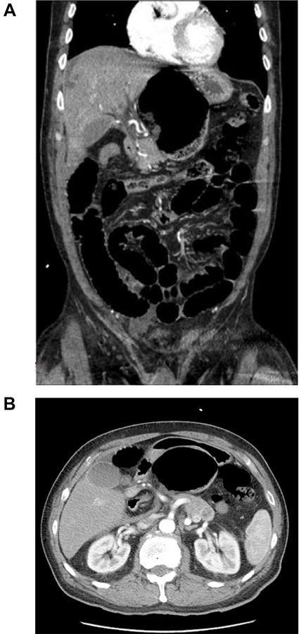 CT scan of the abdomen and pelvis with IV contrast. (A) Coronal view shows internal herniation of the cecum through the foramen of Winslow. (B) Axial view demonstrates the same findings with the stomach displaced both laterally and anteriorly by the cecum. Of note there was 1.5-cm ring-enhancing lesion located in the body of the pancreas found incidentally.