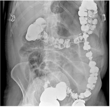 Barium enema demonstrating a transition point in the hepatic flexure with contrast angling towards the lesser sac.