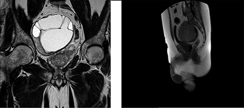 MRI of the pelvis in the Coronal Plane (left) and Sagittal Plane (right) demonstrating a 115 × 105 × 92-mm sacral schwannoma, displacing the prostate and rectum to the left side.