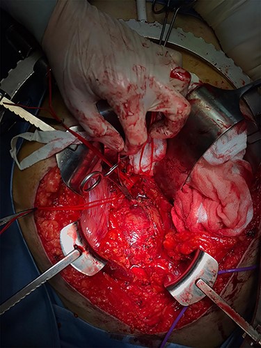 Intraoperative image of surgical resection through a supraumbilical-pubic laparotomy (anterior approach) showing the absence of a clear cleavage plane.