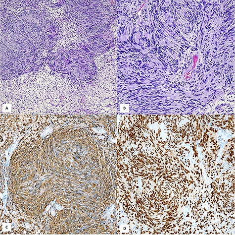 Histopathological examination showed a neoplastic proliferation composed of cellular Antoni A areas alternating with hypocellular Antoni B areas (A,×100, H&E). In cellular areas were encountered the so-called ‘Verocay bodies’ represented by a highly ordered arrangement of Schwann elements separated by fibrillary processes (B, ×200, H&E). Diffuse cytoplasmic immunostaining with S-100 (C, ×200, Mayer’s hemalum counterstain). Strong nuclear positivity with SOX-10 (D, ×200, SOX-10 immunohistochemistry).