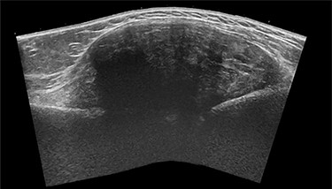 Sagittal panoramic US image of the right shoulder.
