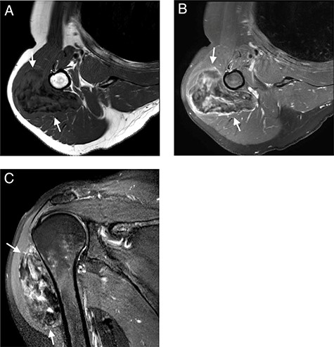 MRI with (A); axial T1-WI; (B) axial T1-FS-WI after administration of intravenous gadolinium contrast and (C) sagittal T2-FS-WI. Heterogeneous tumoral mass indicated with long arrows.