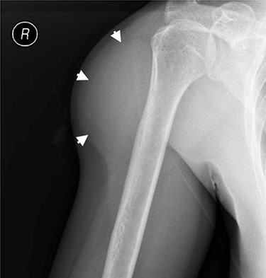 Externally rotated AP radiograph of the right shoulder and upper-arm. Short arrows indicate the tumoral mass.
