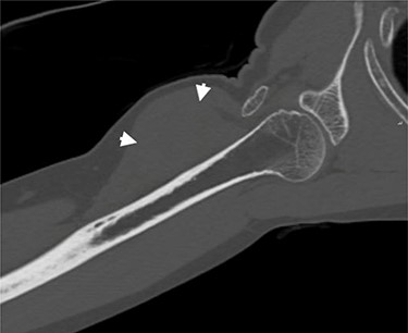 Coronal CT of the right arm. Short arrows indicate the tumoral mass.