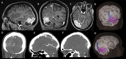 Pre-operative imaging; (A–C) sagittal, coronal and axial T1-weighted MRI images, with gadolinium demonstrating a supra-infratentorial peritorcular tumour; (D–F) CT venogram showing the patency of the straight sinus (number 1) and the superior sagittal sinus (number 2); (G and H) 3D model of the tumour, brain and dural venous sinuses generated using both the MRI images and CT venogram.