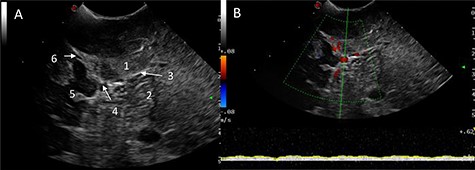 IoUS initial assessment; (A) B-mode image of the surgical field; 1, supratentorial tumour; 2, infratentorial tumour; 3, tentorium; 4, straight sinus; 5, contralateral occipital lobe; 6, falx; (B) triplex Doppler of the straight sinus: combined 2D image with overlay of the colour and pulse wave Doppler demonstrating unidirectional flow from the vein of Galen and the tributary veins of the tentorium.