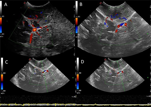 Intraoperative images at the end of resection; Duplex US images (2D image with overlay of colour Doppler) of the initial appearances of the straight sinus (A) and appearance at the end of resection (B); a bidirectional flow in the straight sinus is apparent after tumour resection, this was not present prior to tumour debulking; the Triplex Doppler confirms the bidirectional flow in the straight sinus (C and D).