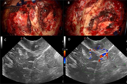 Correlation of US appearance and gross anatomy; (A and B) intraoperative picture of the surgical field at the end of resection; (C and D) final US assessment—B-mode (C) and duplex (D); 1, ipsilateral occipital lobe; 2, ipsilateral cerebellar hemisphere; 3, strip of bone on top of the transverse sinus; 4, supratentorial resection cavity; 5, infratentorial resection cavity; 6, torcular; 7, supra-infratentorial communication of the tumour via the tentorium; 8, straight sinus; 9, contralateral occipital lobe; 10, falx cerebri; 11, tentorium.