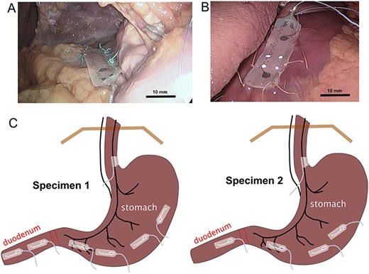 GI planar electrode placements. (A) electrode positioning on duodenum, with initial sutures. (B) electrode on stomach. (C) Diagram of final electrode positions on the stomach (and vagus nerve). Bar = approximate scale with greater accuracy in the foreground.
