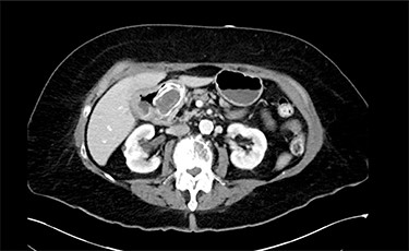 Abdominal CT scan (axial plane) showing gallstone in the duodenum with a cholecystoduodenal fistula.