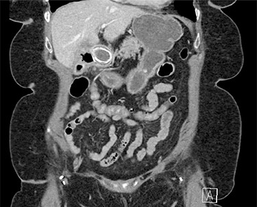 Abdominal CT scan (coronal plane) with the large impacted gallstone causing gastric outlet obstruction proximally with no small bowel dilation distally.