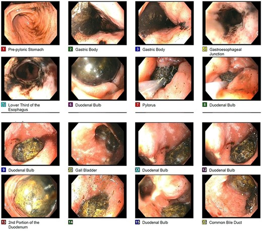 Endoscopic picture of large impacted gallstone in the duodenum with noted cholecystoduodenal fistula noted on image 15.