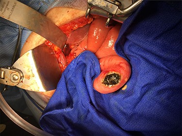 Distal gallstone causing gallstone ileus with proximal enterotomy for extraction.