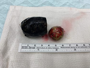 Larger gallstone on the left measuring 3.4 cm removed from distal small bowel. Smaller gallstone on the right measuring 2 cm removed from second portion of duodenum.