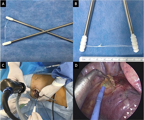 Connected cotton swabs and intraoperative view. (A) The connected cotton swabs. (B) The heads of two cotton swabs are connected by an ~7-cm long silk thread. (C) The forceps and the electrocautery are introduced from the incision by the surgeon. The assistant is holding the rigid 5-mm 30-degree video-thoracoscope and connected cotton swabs. The operator’s and assistant’s hands can be positioned with no interference between the instruments. (D) Intraoperative view of right subcarinal lymphadenectomy in the middle lobectomy. The cotton heads and silk thread is retracting the lung, creating a good surgical field (white arrowheads).
