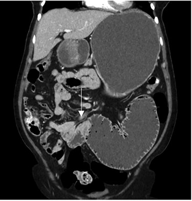 CT imaging—coronal view showing the transition point in the jejunum.