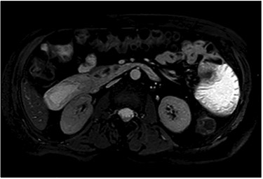MRI—axial view showing the tumor.