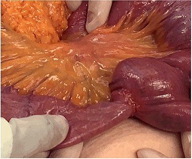Stricturing lesion. The proximal small bowel was significantly dilated however, distally was viable and decompressed.