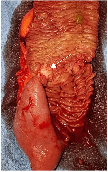 Small bowel lumen. The mucosa itself was relatively unremarkable in appearance with a tight fibrotic submucosal lesion (arrow).
