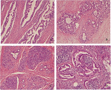 (A) Well-differentiated adenocarcinoma infiltrating muscularis propria. (B) Pancreatic adenocarcinoma showing perineural invasion. (C) Heterotopic benign pancreatic tissue, acini and ducts (Heinrich type 2) in the submucosa adjacent to PAIN and infiltrating cancer. (D) Carcinoma invading mesenteric lymph node.