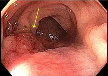 Colonoscopy showing non obstructing sigmoid mass.