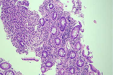 Histology slide of the biopsy with H&E staining showing poorly differentiated carcinoma.